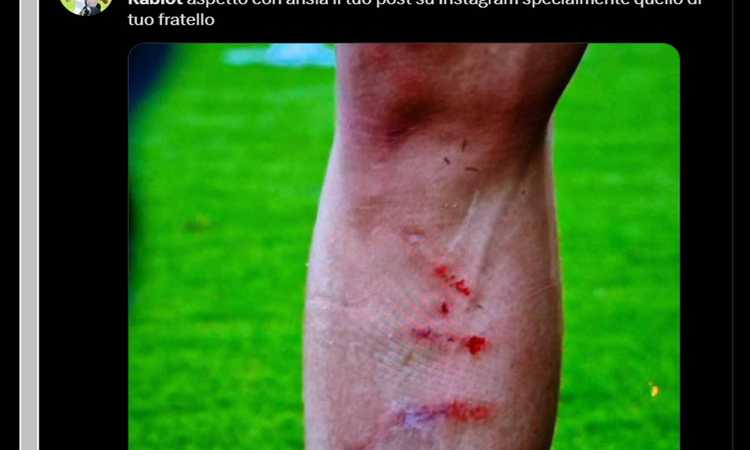 Rabiot, spunta la FOTO della gamba sanguinante. L’ira dei tifosi: ‘Uefa vergogna, questa è malafede!’